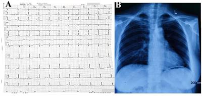 Case Report: “Gourd-Shaped” Heart Strangled by Localized Annular Calcification of the Left Ventricle: A Rare Case of Constrictive Pericarditis